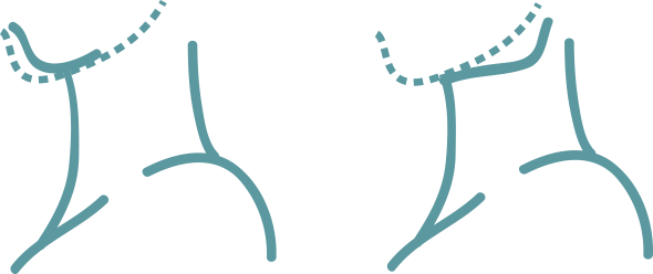 Genioplasty