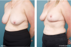 Breast before after - Ethicos Institute