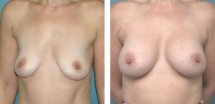 Breast_aug_2