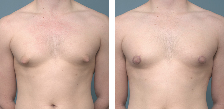 Male Breast before after - Ethicos Institute