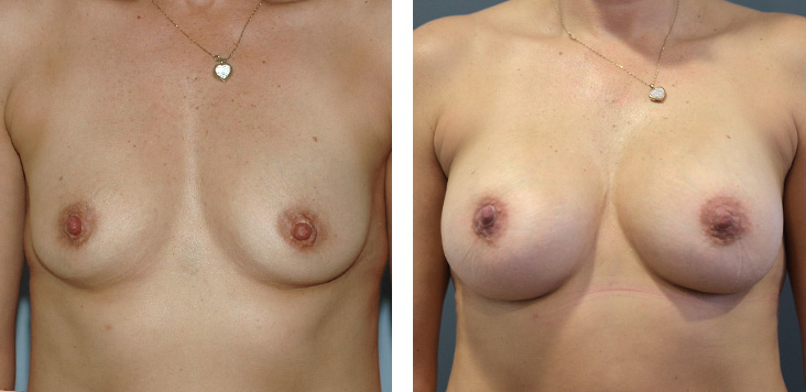 breast_aug_4