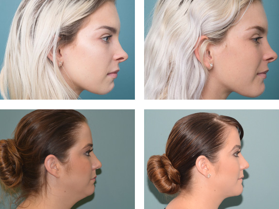 Genioplasty perth