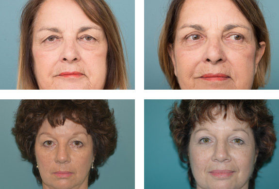 Eyelid Surgery - Ethicos Institute Cottesloe