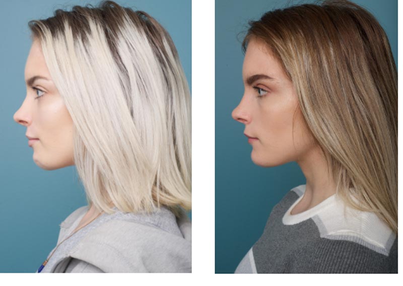 Genioplasty - Ethicos Institute
