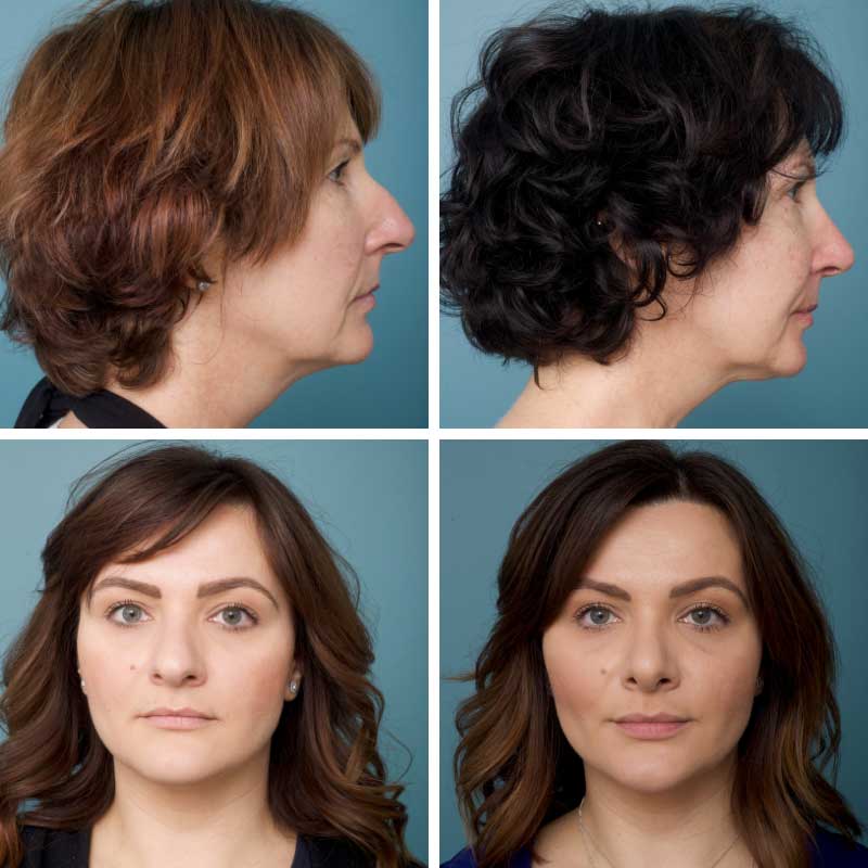 Rhinoplasty - Ethicos Institute