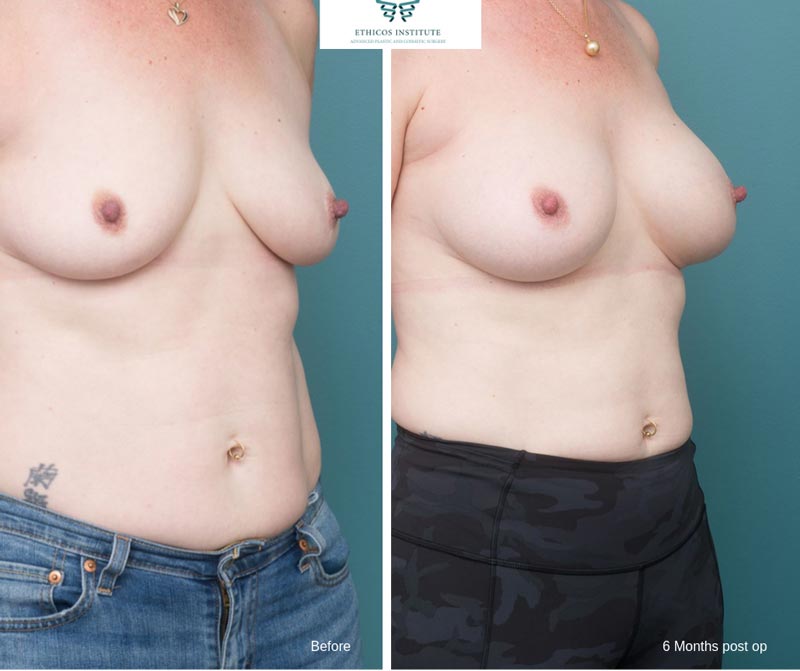 Breast Augmentation - Ethicos Institute
