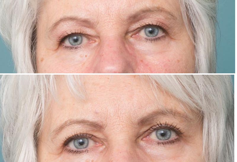 Eyelid Surgery - Ethicos Institute