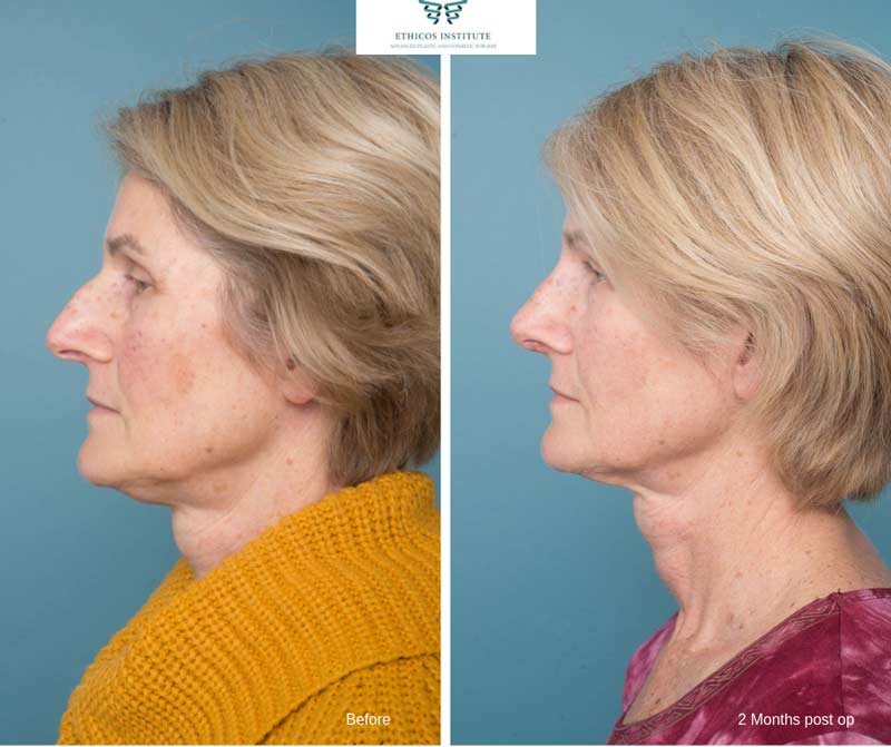 Nose Surgery - Ethicos Institute
