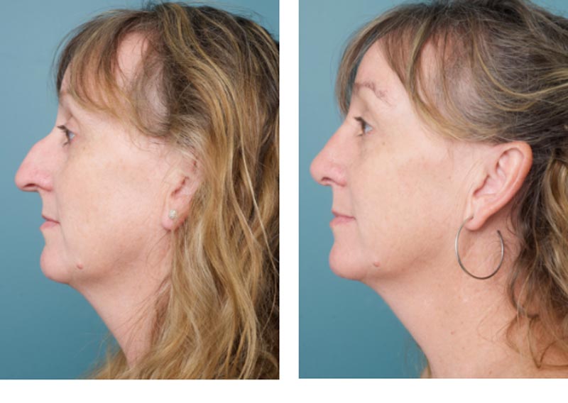 Rhinoplasty - Ethicos Institute