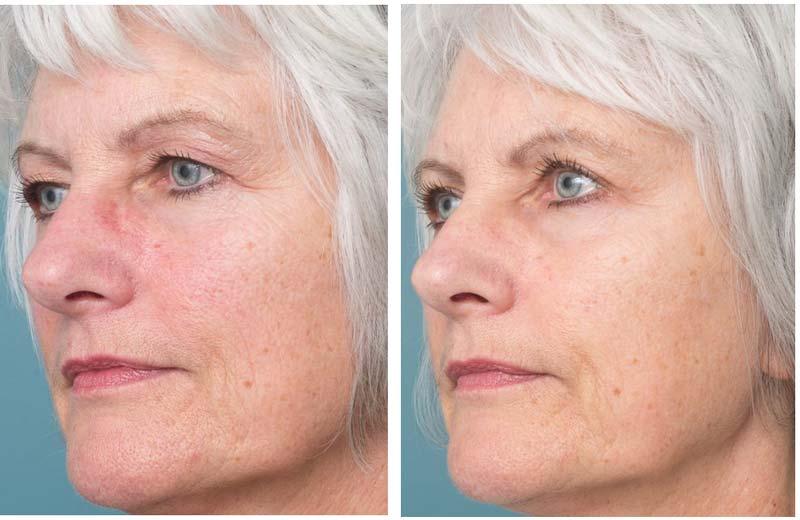 Eyelid Surgery - Ethicos Institute