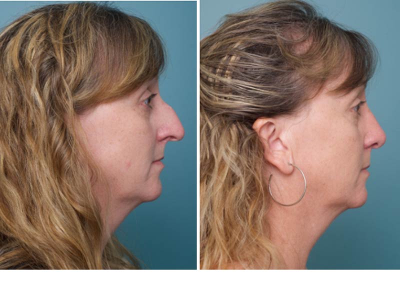 Nose Surgery - Ethicos Institute