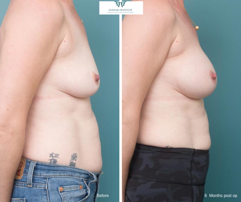 Breast Augmentation - Ethicos Institute