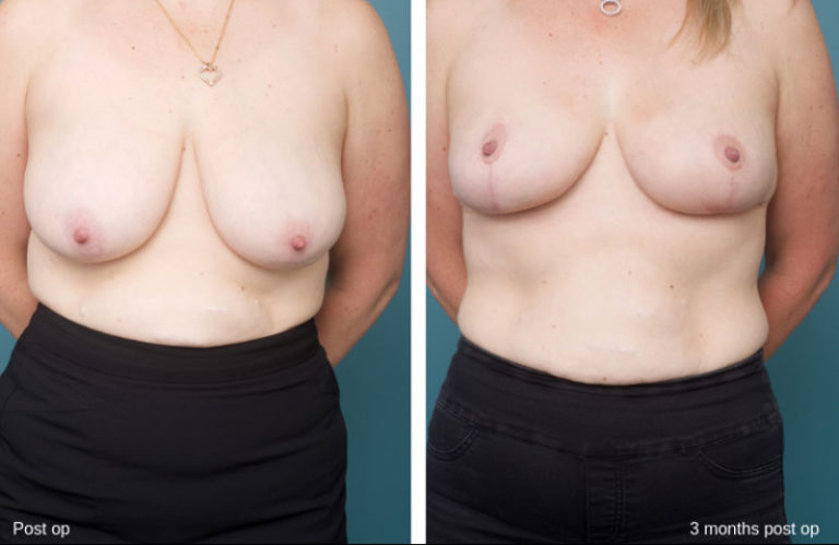 Breast Reduction - Ethicos Institute