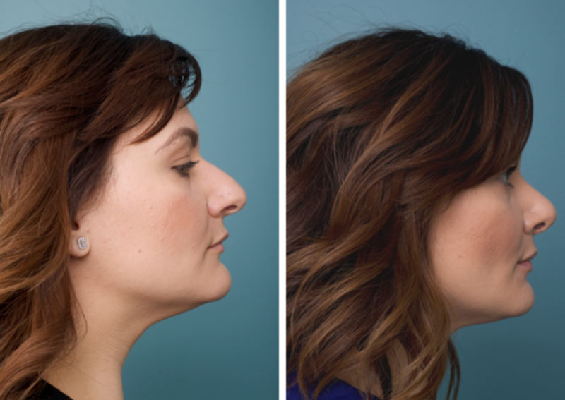 Nose Surgery - Ethicos Institute