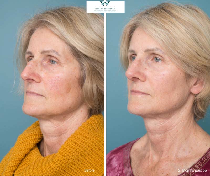 Rhinoplasty - Ethicos Institute