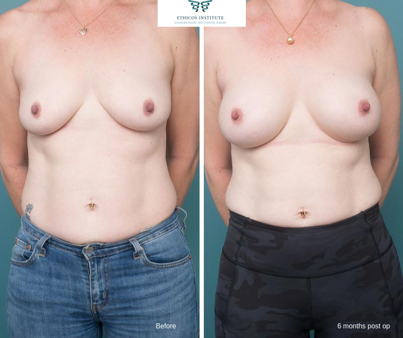 Breast Augmentation - Ethicos Institute