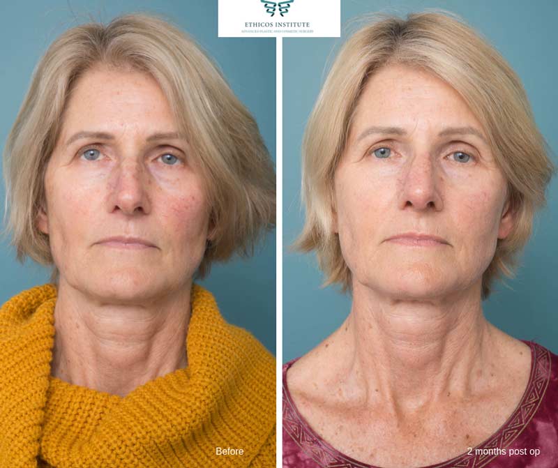 Nose Surgery - Ethicos Institute