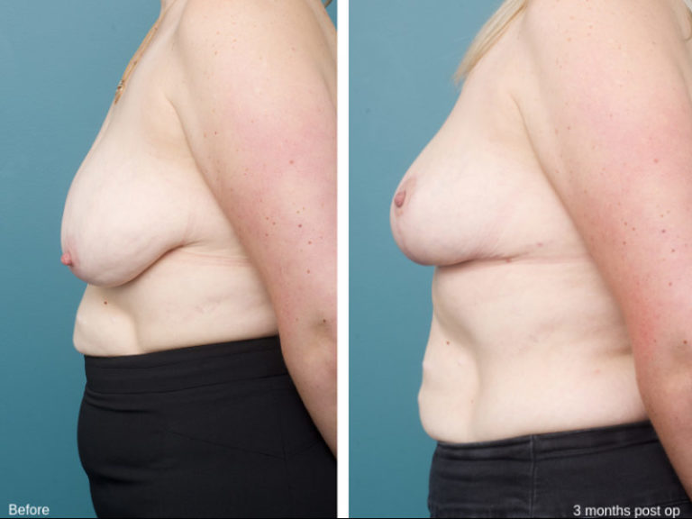 Breast Reduction - Ethicos Institute