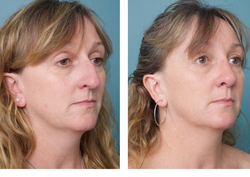 Nose Surgery - Ethicos Institute
