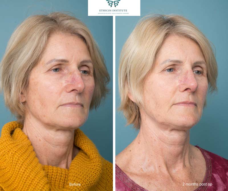 Nose Surgery - Ethicos Institute