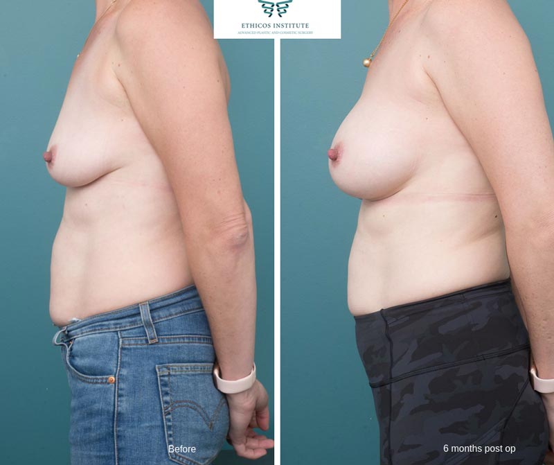 Breast Augmentation - Ethicos Institute