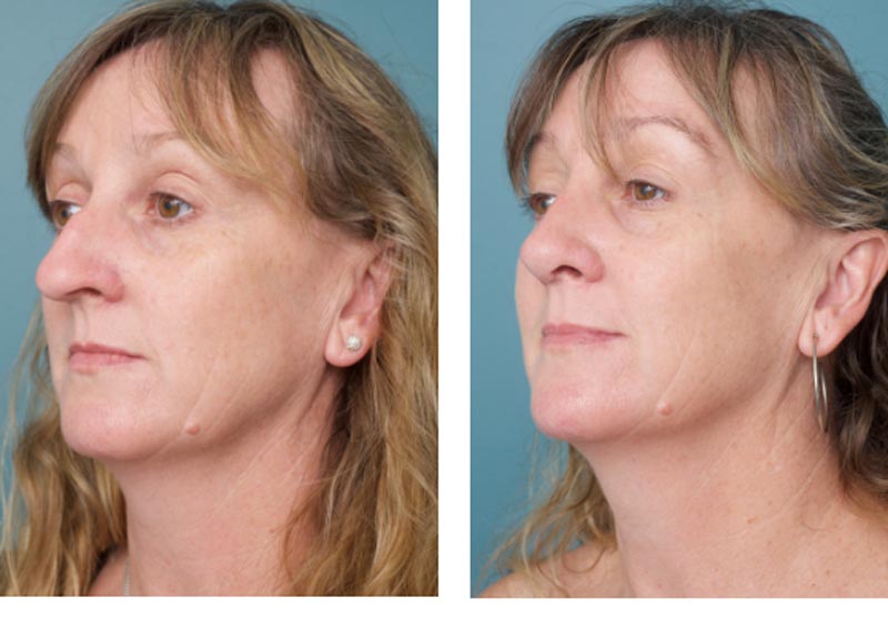 Rhinoplasty - Ethicos Institute