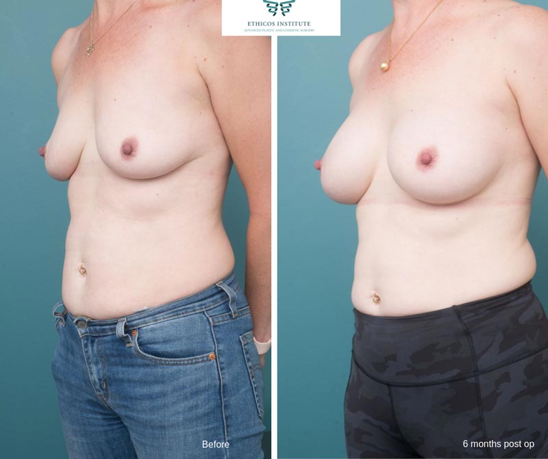 Breast Augmentation - Ethicos Institute
