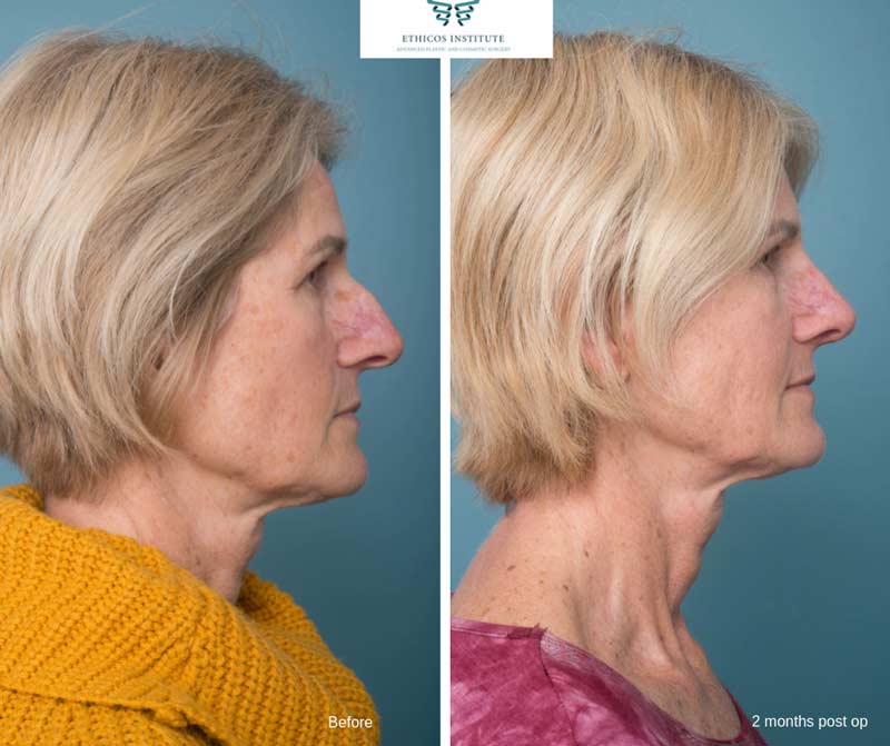 Nose Surgery - Ethicos Institute