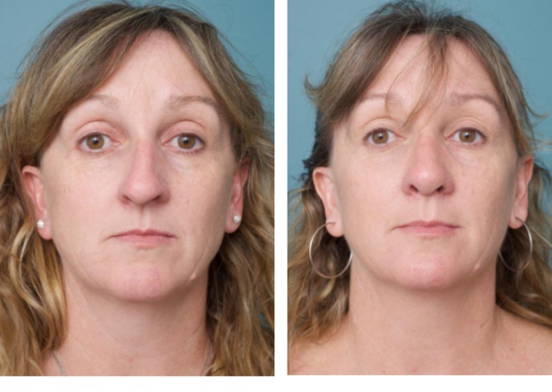 Nose Surgery - Ethicos Institute