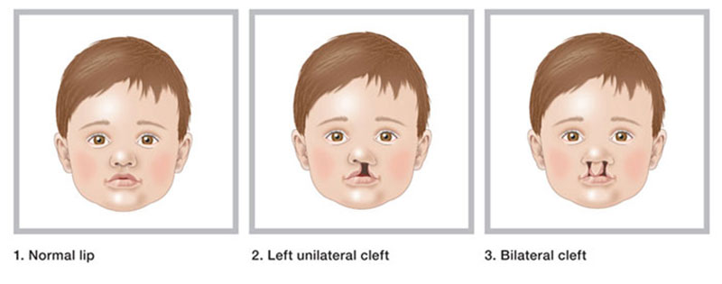 Cleft Lip and Palate - Ethicos Institute
