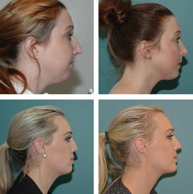 Genioplasty - Ethicos Institute