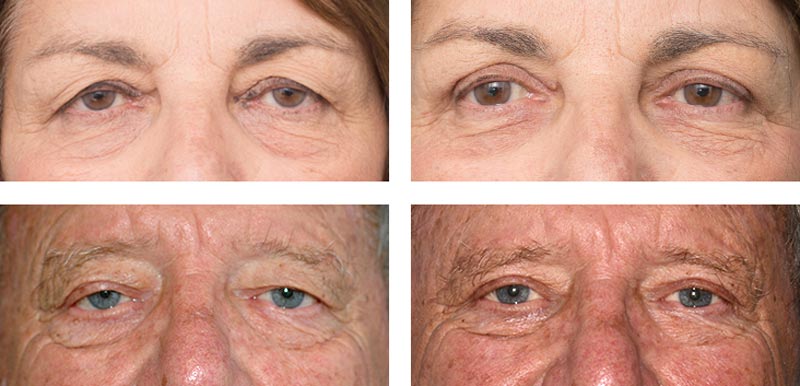 Eyelid Surgery - Ethicos Institute