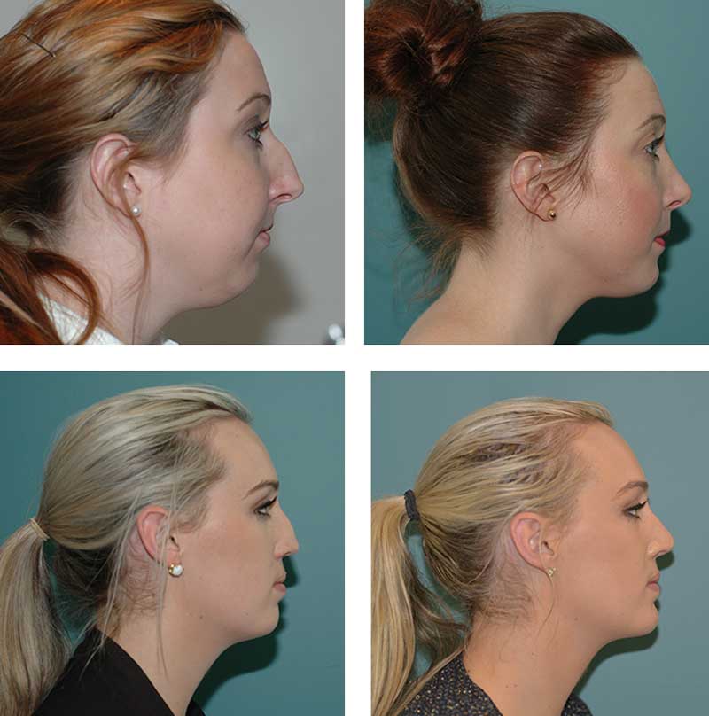 Rhinoplasty - Ethicos Institute