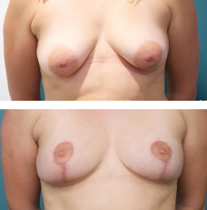 Breast Lift - Ethicos Institute