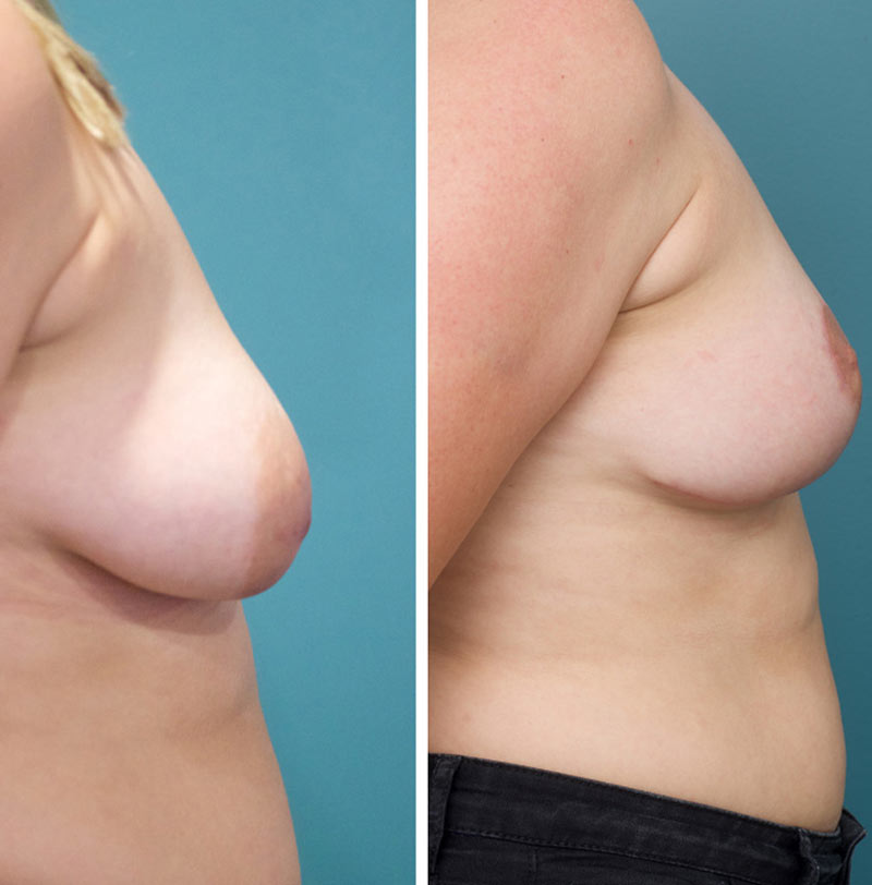 Breast Lift - Ethicos Institute