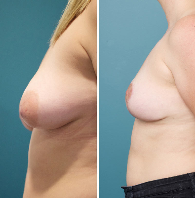 Breast Lift - Ethicos Institute