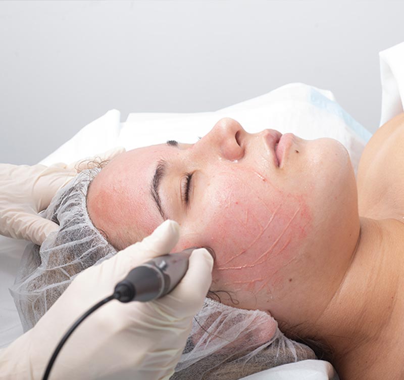 Medical Skin Needling - Ethicos Institute