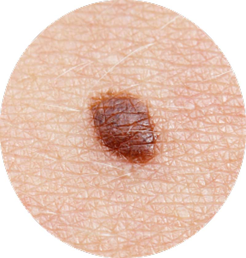 Basal Cell Carcinoma - Ethicos Institute