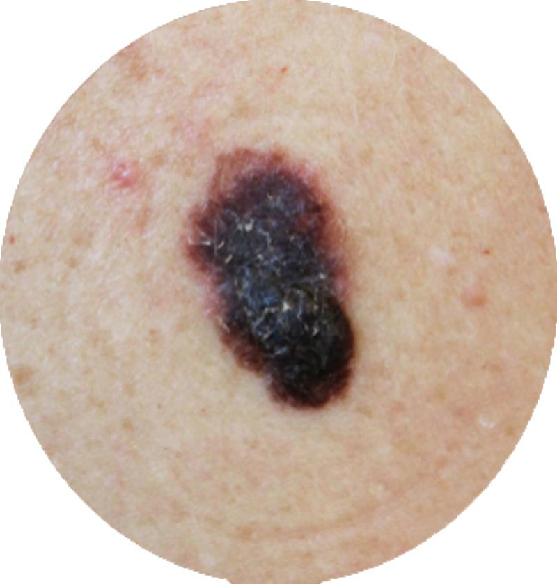 Melanoma - Ethicos Institute
