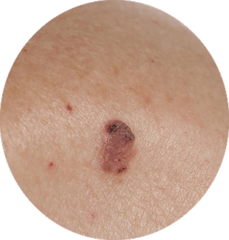 Squamous Cell Carcinoma - Ethicos Institute