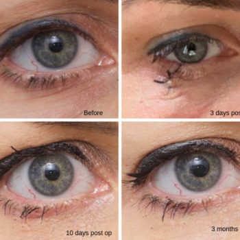 Removal of Skin Cancer - Ethicos Institute